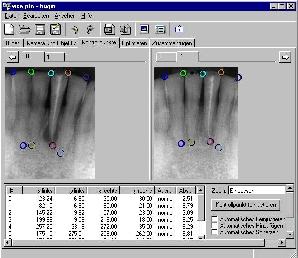 HugIn Kontrollpunkte auf den Rntgenbildern setzen