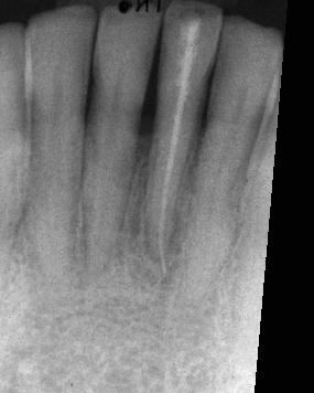 Röntgenbild Zahn mit ImageJ und Turboreg umgerechnet