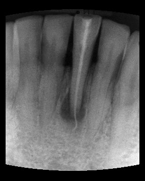 Röntgenbild Zahn normiert