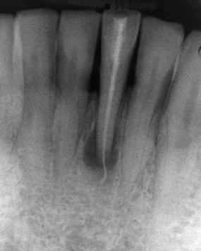 Röntgenbild Zahn Original