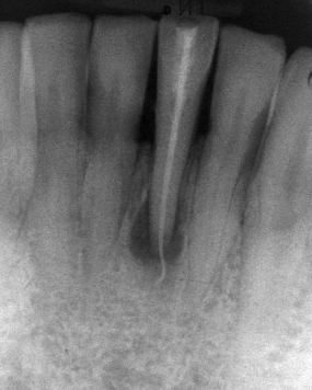 Wurzelfllung Wurzelbehandlung Guttapercha berstopfung Heilung Rntgenbild