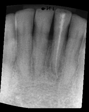 Röntgenbild Zahn normiert