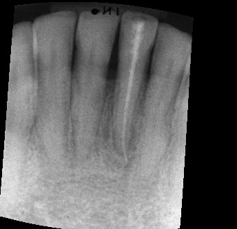 Röntgenbild Zahn Original